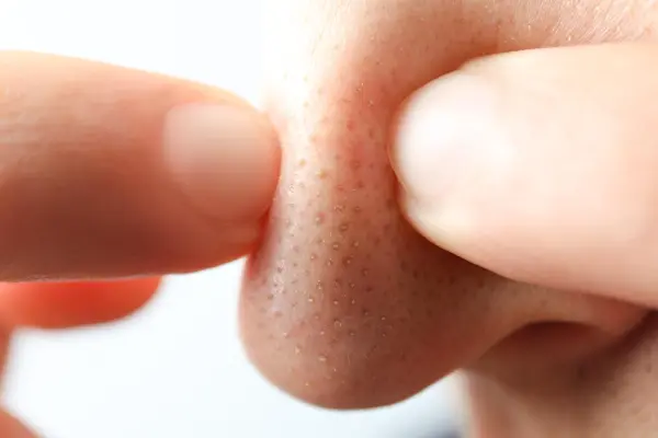 Los puntos negros en la nariz son una de las imperfecciones más comunes del rostro, ya que esta zona suele acumular grasa y residuos con facilidad. Si te preguntas cómo...